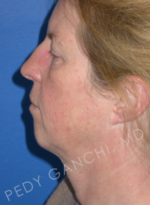 Face / Neck Lift