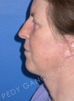 Face / Neck Lift