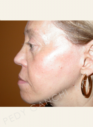 Face / Neck Lift