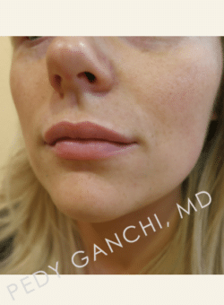 Lip Augmentation