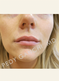 Lip Augmentation