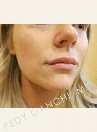 Lip Augmentation