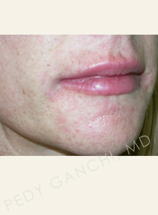 Lip Augmentation