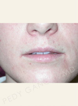 Lip Augmentation