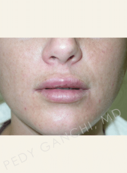 Lip Augmentation