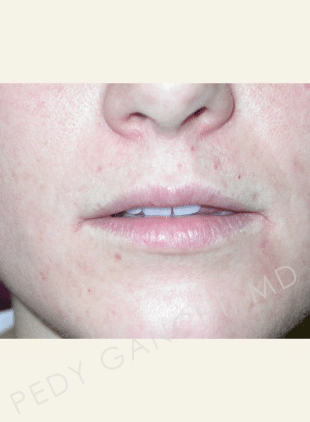 Lip Augmentation