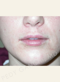 Lip Augmentation