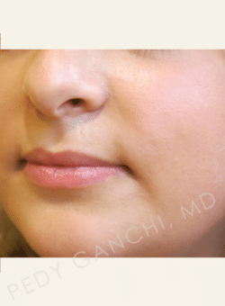 Lip Augmentation