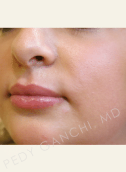 Lip Augmentation