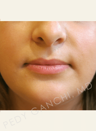 Lip Augmentation