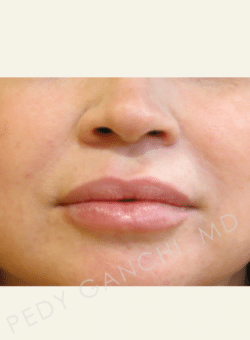 Lip Augmentation