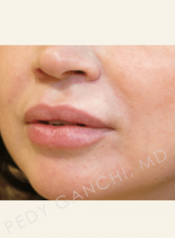 Lip Augmentation