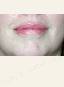 Lip Augmentation