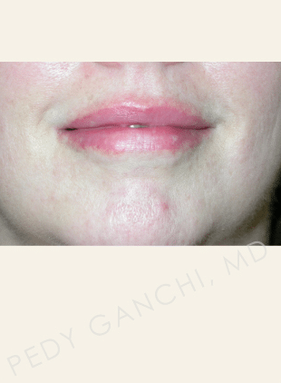 Lip Augmentation