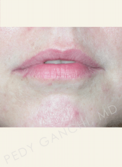 Lip Augmentation