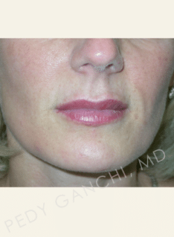 Lip Augmentation