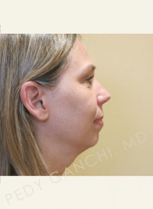 Chin Augmentation - Neck Liposuction