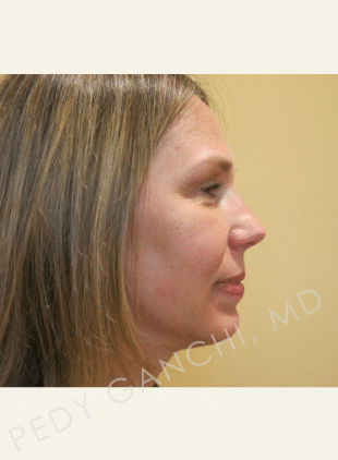 Chin Augmentation - Neck Liposuction