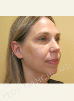 Chin Augmentation - Neck Liposuction