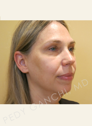 Chin Implant-Neck Liposuction