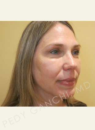 Chin Augmentation - Neck Liposuction