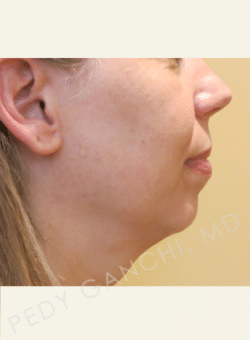 Chin Augmentation - Neck Liposuction