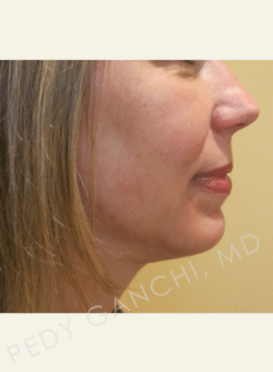 Chin Augmentation - Neck Liposuction