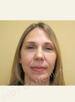 Chin Augmentation - Neck Liposuction