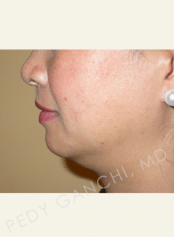 Chin Augmentation - Neck Liposuction