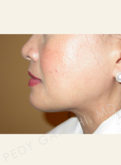 Chin Implant-Neck Liposuction