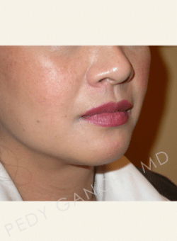 Chin Augmentation - Neck Liposuction