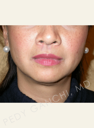 Chin Augmentation - Neck Liposuction