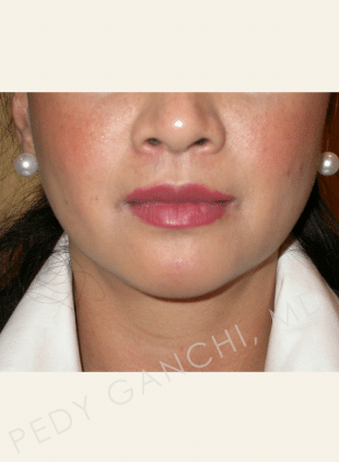 Chin Augmentation - Neck Liposuction