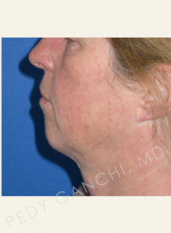 Chin Augmentation - Neck Liposuction