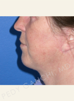 Chin Augmentation - Neck Liposuction