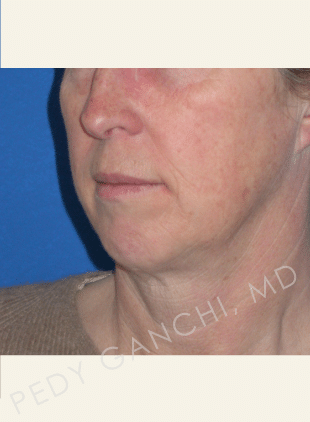 Chin Augmentation - Neck Liposuction