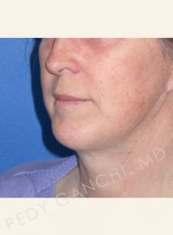 Chin Augmentation - Neck Liposuction