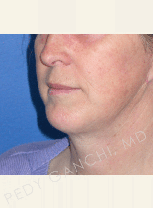 Chin Augmentation - Neck Liposuction