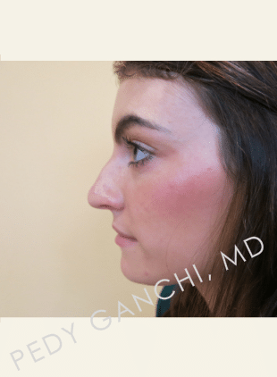 Nasal - Rhinoplasty