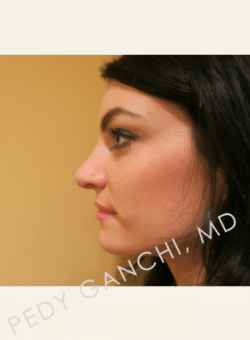 Nasal - Rhinoplasty