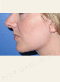 Nasal - Rhinoplasty