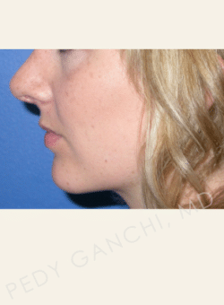 Nasal - Rhinoplasty