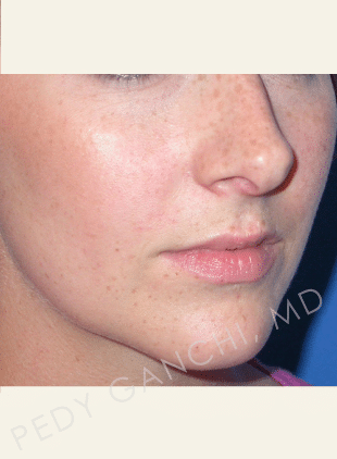 Nasal - Rhinoplasty