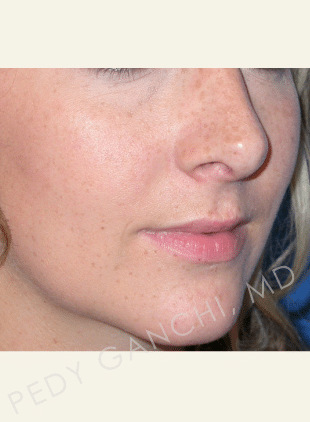 Nasal - Rhinoplasty