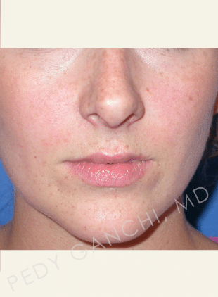 Nasal - Rhinoplasty