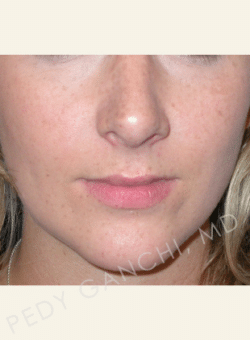 Nasal - Rhinoplasty