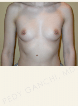 Breast Augmentation (Implants)