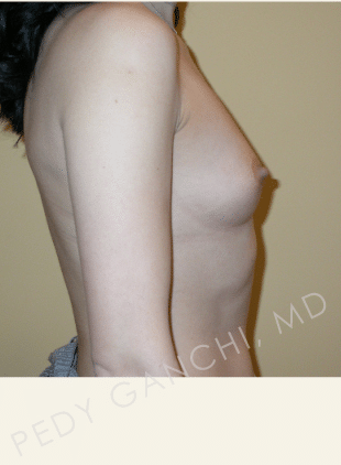 Breast Augmentation (Implants)