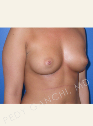 Breast Augmentation (Implants)