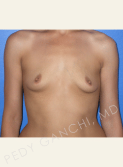 Breast Augmentation (Implants)